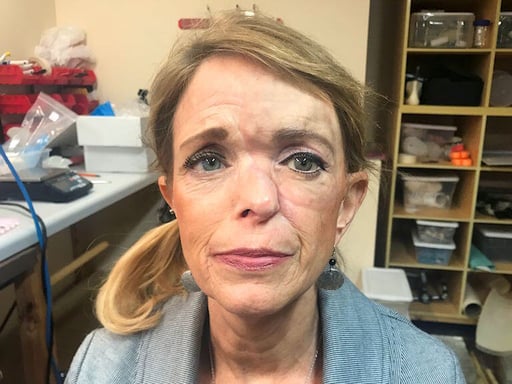 Orbital Prosthesis