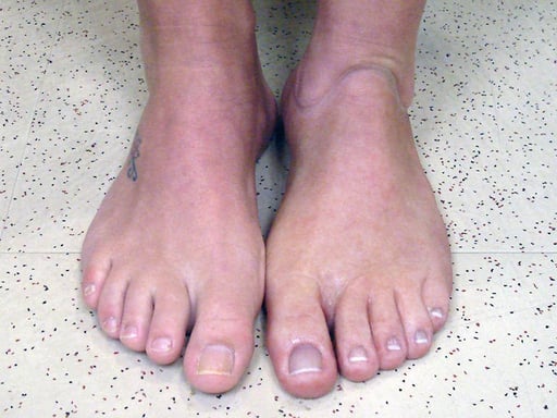 Foot Prosthesis