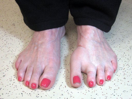 Toe Prosthesis