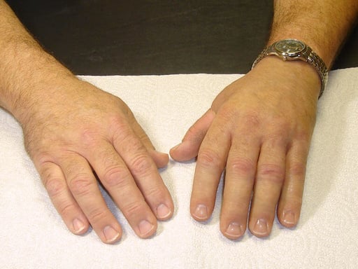 Hand Prosthesis